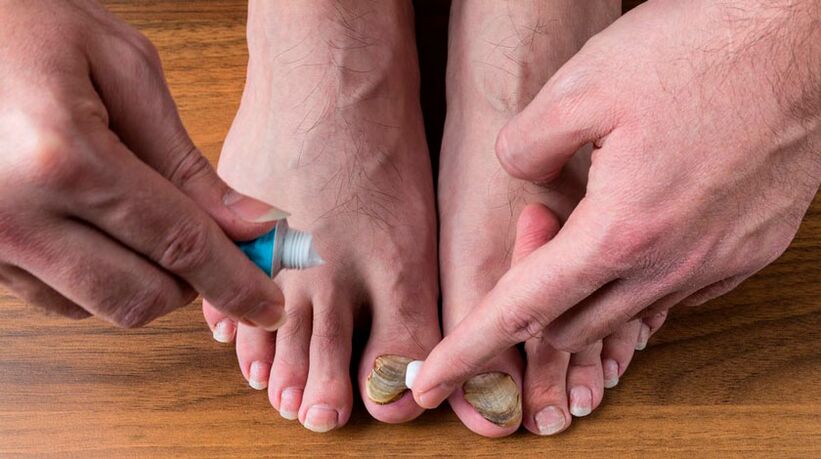 Εφαρμόζοντας μια αντιμυκητιασική κρέμα στα νύχια των ποδιών σας για τη θεραπεία της ονυχομυκητίασης