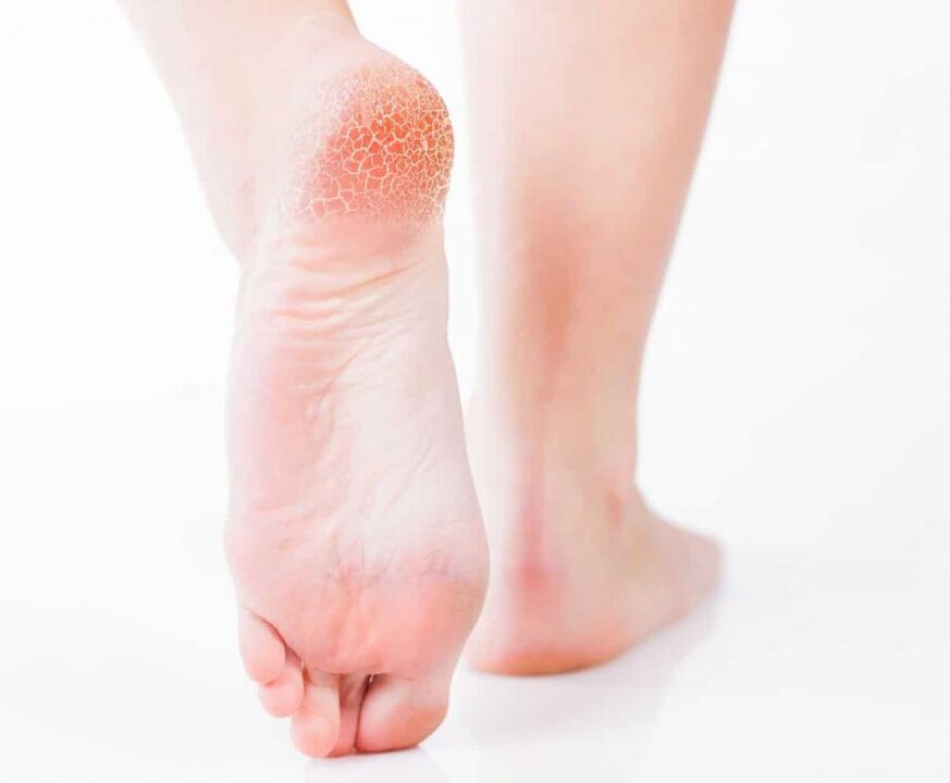 Κηλίδες στο πόδι με ρουβρομύκωση