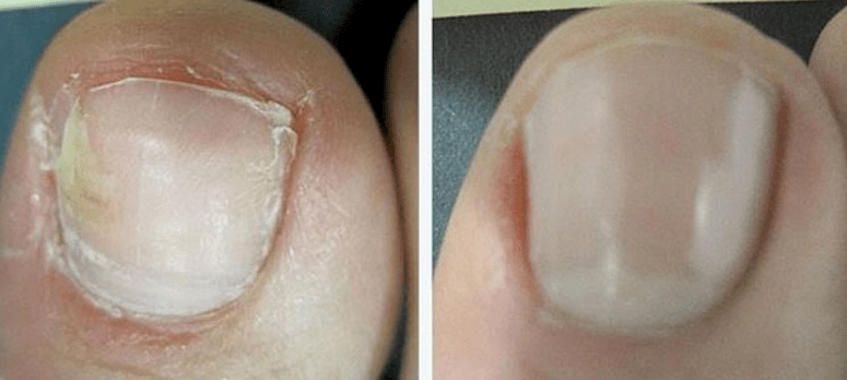 Νύχι των ποδιών πριν και μετά τη θεραπεία του μύκητα