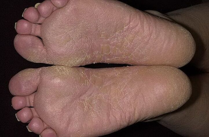 Το ξηρό, ξεφλουδισμένο δέρμα στα πόδια είναι σημάδι φολιδωτών μυκητιάσεων