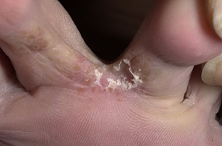 Το σκασμένο δέρμα ανάμεσα στα δάχτυλα των ποδιών σας είναι σύμπτωμα ενός ενδογενούς μύκητα