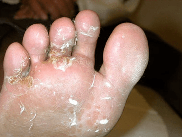την ανάπτυξη μυκήτων στα δάχτυλα των ποδιών