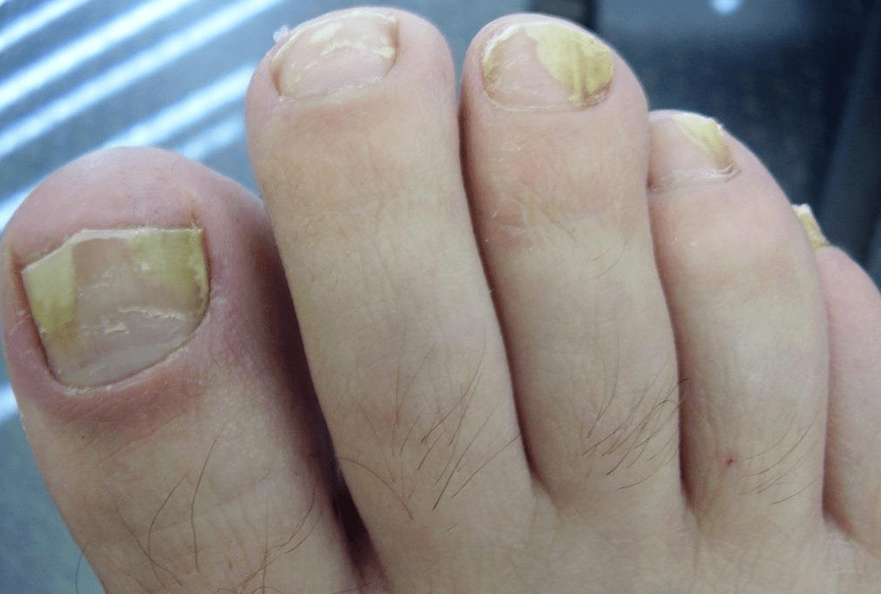 Κίτρινα νύχια από μυκητίαση