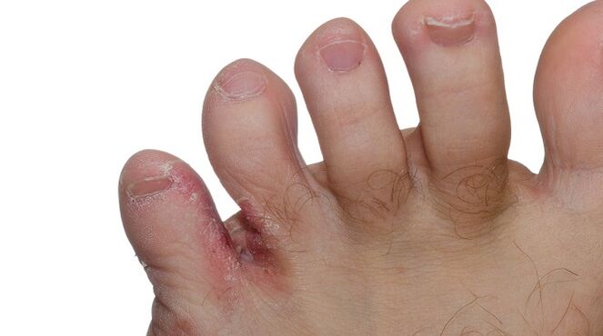 Σημάδια μύκητα ανάμεσα στα δάχτυλα των ποδιών – ρωγμές και ξεφλούδισμα του δέρματος