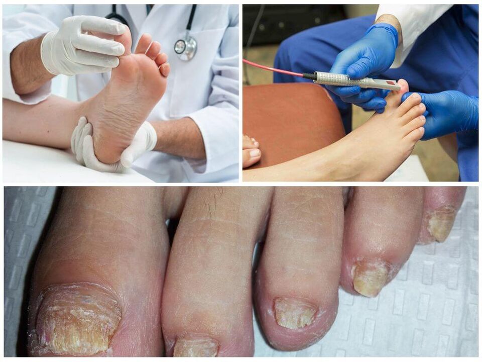 Ένας γιατρός διαγιγνώσκει και θεραπεύει τα νύχια των ποδιών που έχουν προσβληθεί από μυκητιασική λοίμωξη. 