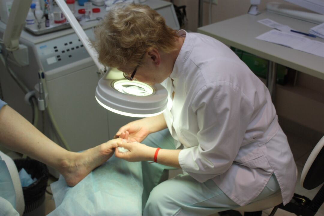 Η εντυπωσιακή ανάπτυξη του μύκητα των νυχιών των ποδιών απαιτεί τη βοήθεια χειρουργού