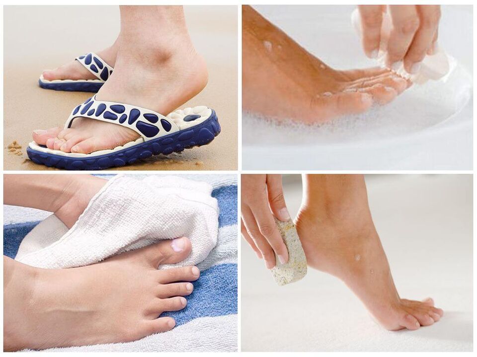 Η πρόληψη της ονυχομυκητίασης περιλαμβάνει υγιεινή των ποδιών, χρήση προσωπικών αντικειμένων και έγκαιρο πεντικιούρ